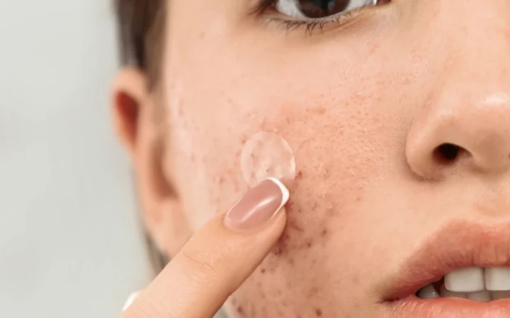 آیا خمیردندان برای جوش صورت خوب است؟ نظر متخصص پوست + عوارض